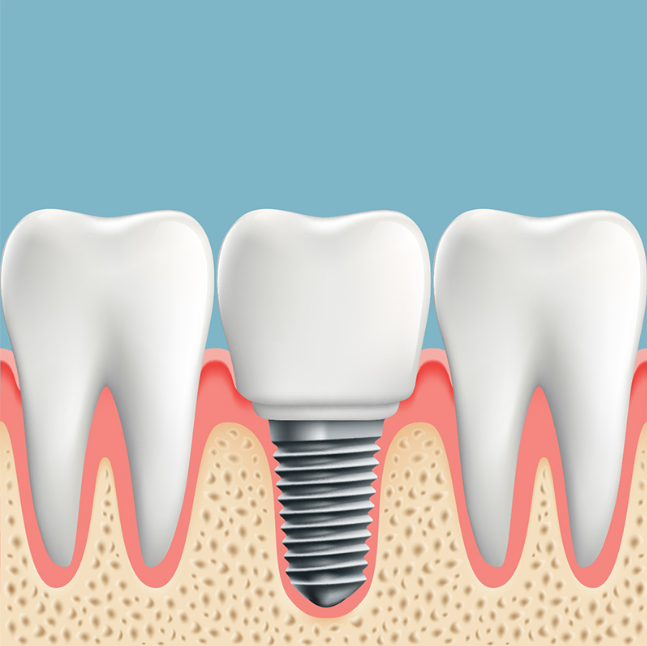 Dental Implant